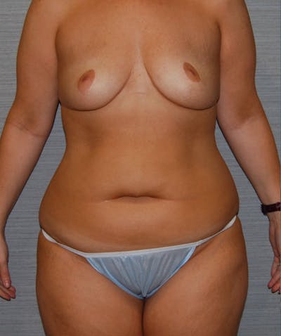 Abdominal Skin Excision Before & After Gallery - Patient 133023548 - Image 1