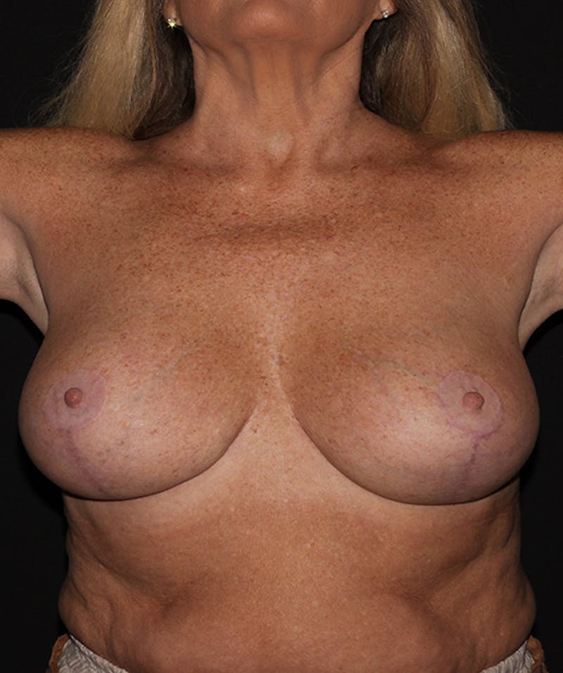 Breast Reduction Before & After Gallery - Patient 133023558 - Image 4