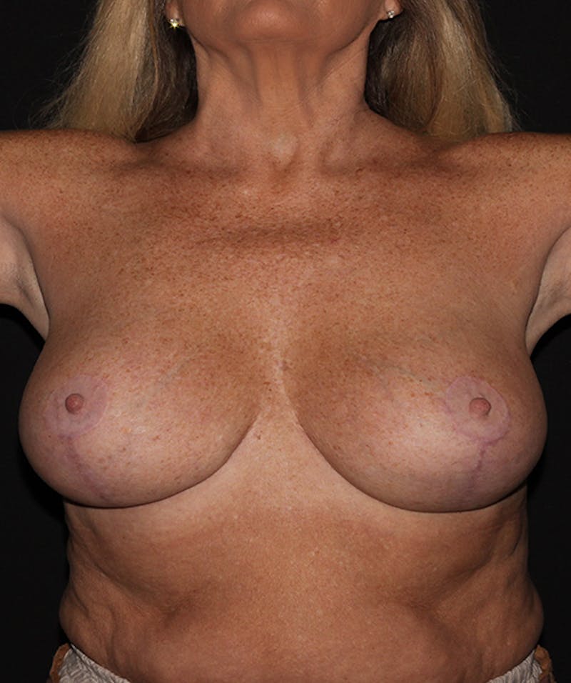 Breast Reduction Before & After Gallery - Patient 133023558 - Image 4