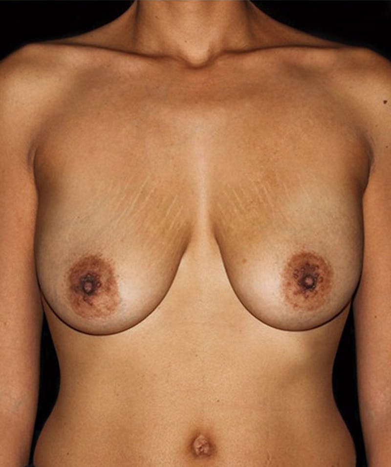 Breast Lift with Implants Before & After Gallery - Patient 133023553 - Image 1