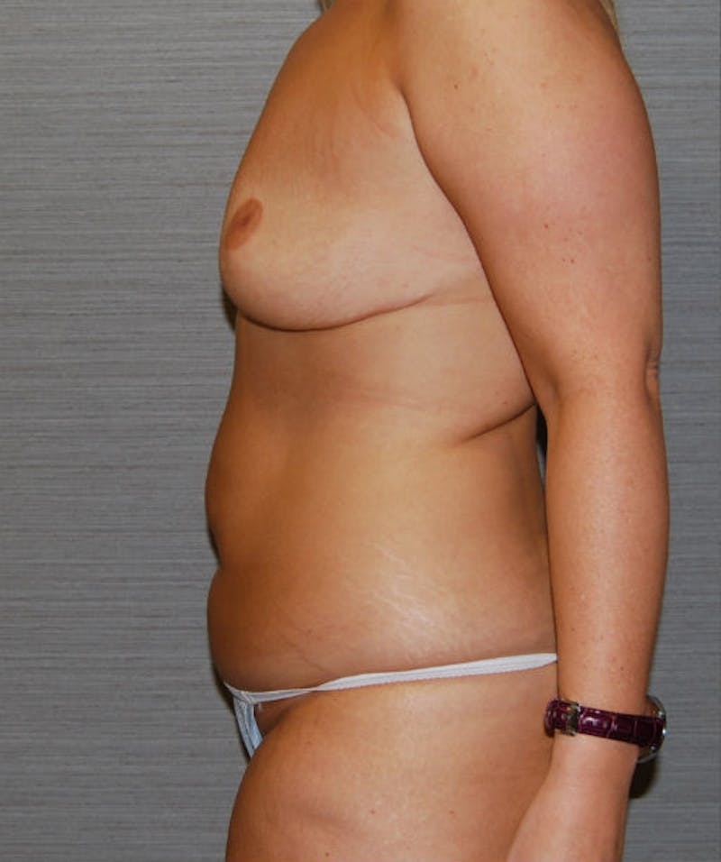 Abdominal Skin Excision Before & After Gallery - Patient 133023548 - Image 5