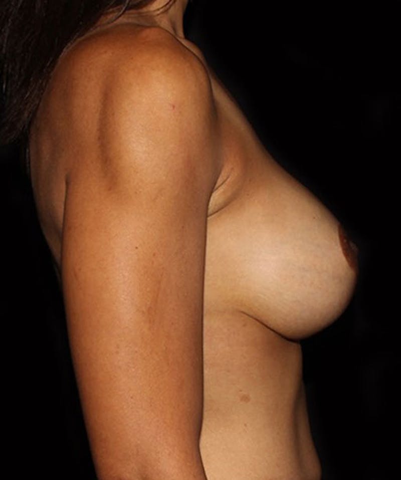 Breast Lift with Implants Before & After Gallery - Patient 133023553 - Image 6