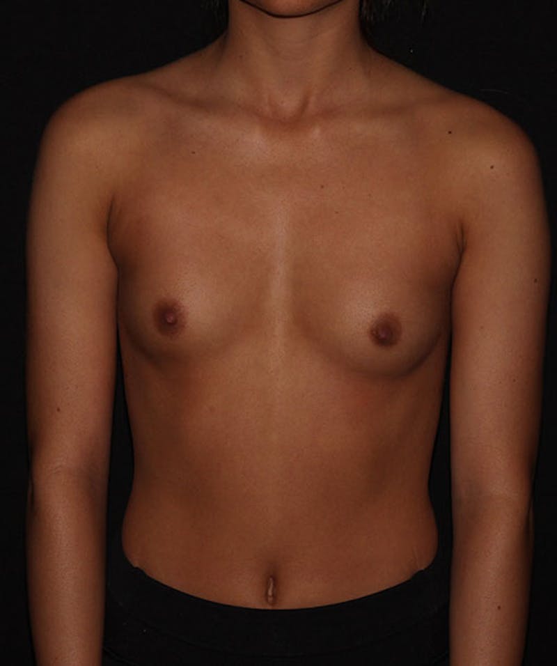 Breast Augmentation Before & After Gallery - Patient 133023561 - Image 1