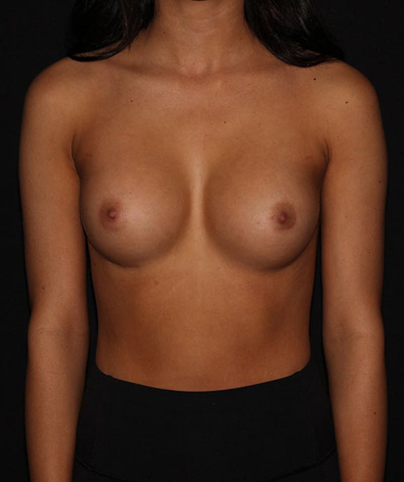 Breast Augmentation Before & After Gallery - Patient 133023561 - Image 2