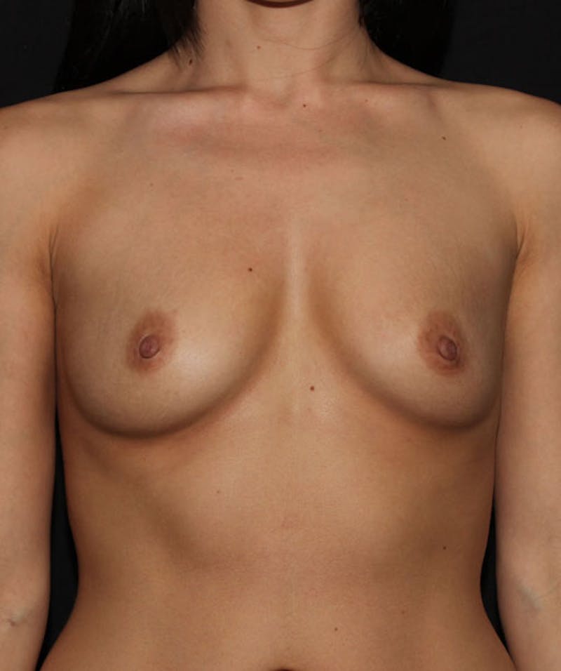 Sientra Breast Implants Before & After Gallery - Patient 133023565 - Image 1