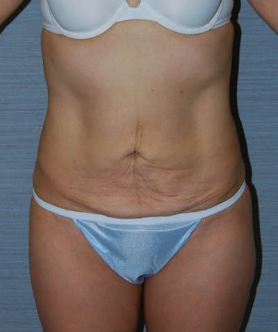 Abdominal Skin Excision Before & After Gallery - Patient 133023559 - Image 1