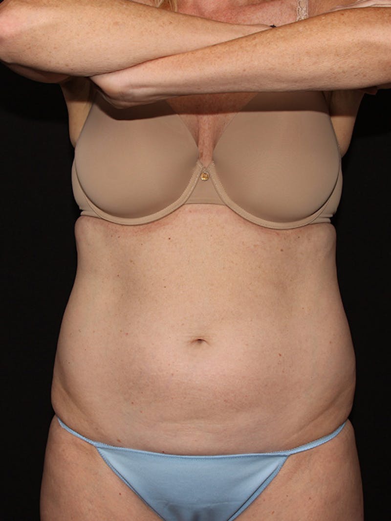 Abdominal Skin Excision Before & After Gallery - Patient 133023574 - Image 1