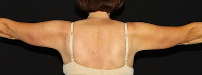 Arm Lift Before & After Gallery - Patient 133023568 - Image 1