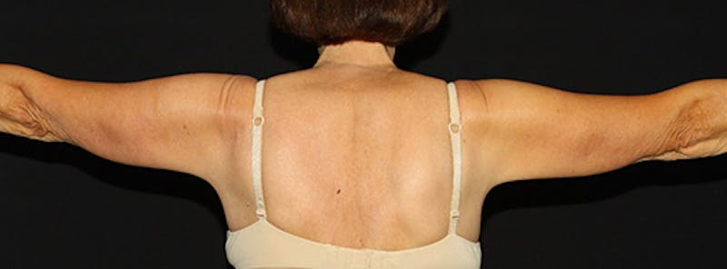 Arm Lift Before & After Gallery - Patient 133023568 - Image 1