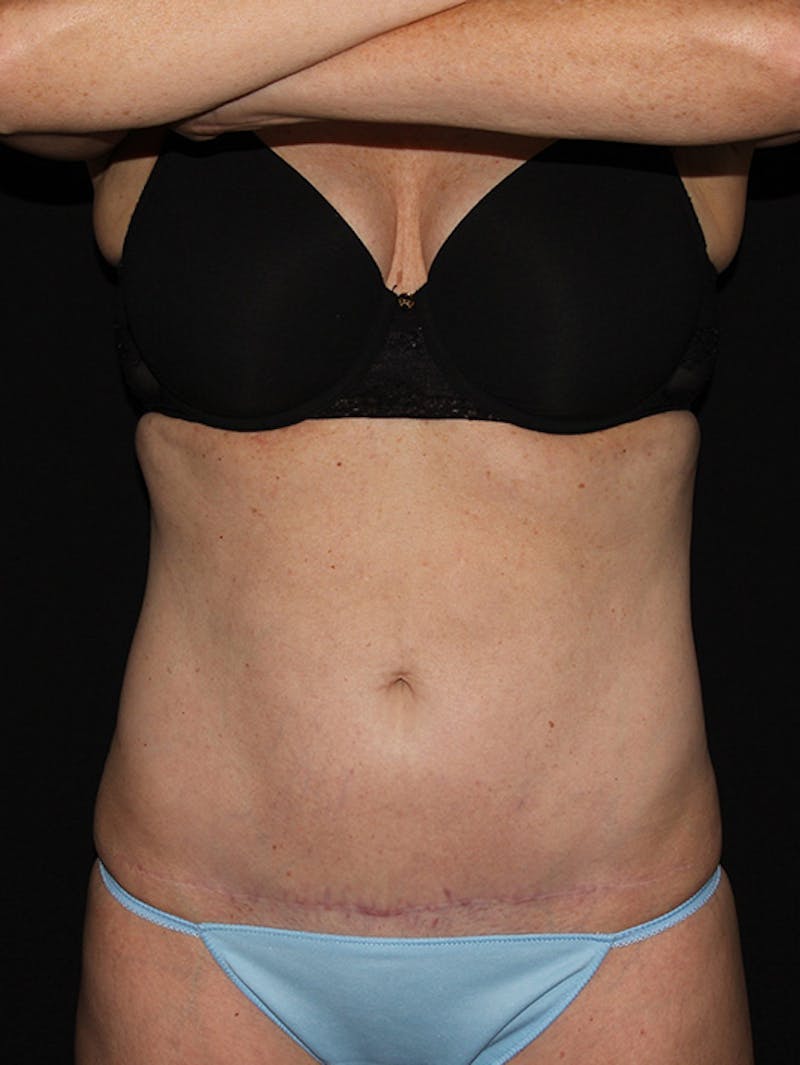 Abdominal Skin Excision Before & After Gallery - Patient 133023574 - Image 2
