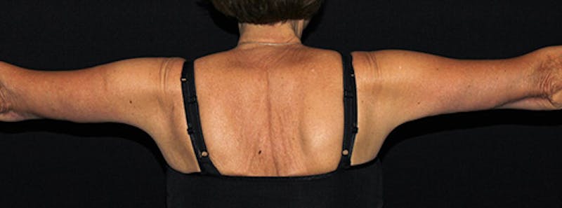 Arm Lift Before & After Gallery - Patient 133023568 - Image 2