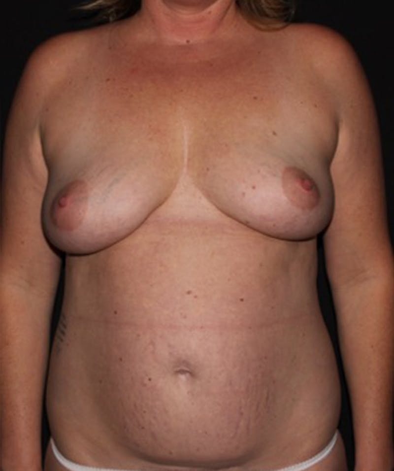Breast Lift with Implants Before & After Gallery - Patient 133023569 - Image 1