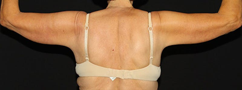 Arm Lift Before & After Gallery - Patient 133023568 - Image 5