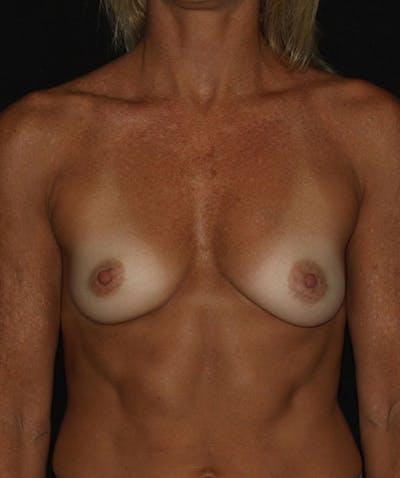 Sientra Breast Implants Before & After Gallery - Patient 133023575 - Image 1