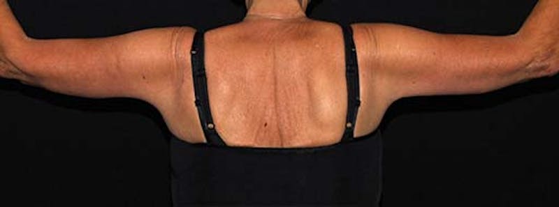 Arm Lift Before & After Gallery - Patient 133023568 - Image 6