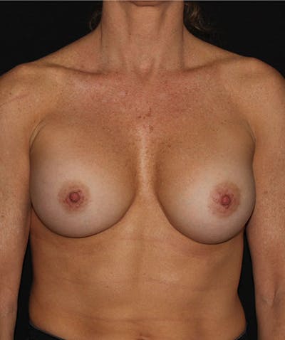 Sientra Breast Implants Before & After Gallery - Patient 133023575 - Image 2