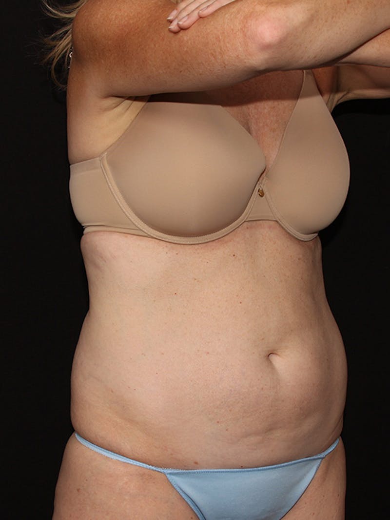 Abdominal Skin Excision Before & After Gallery - Patient 133023574 - Image 7