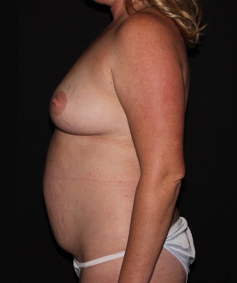Breast Lift with Implants Before & After Gallery - Patient 133023569 - Image 5