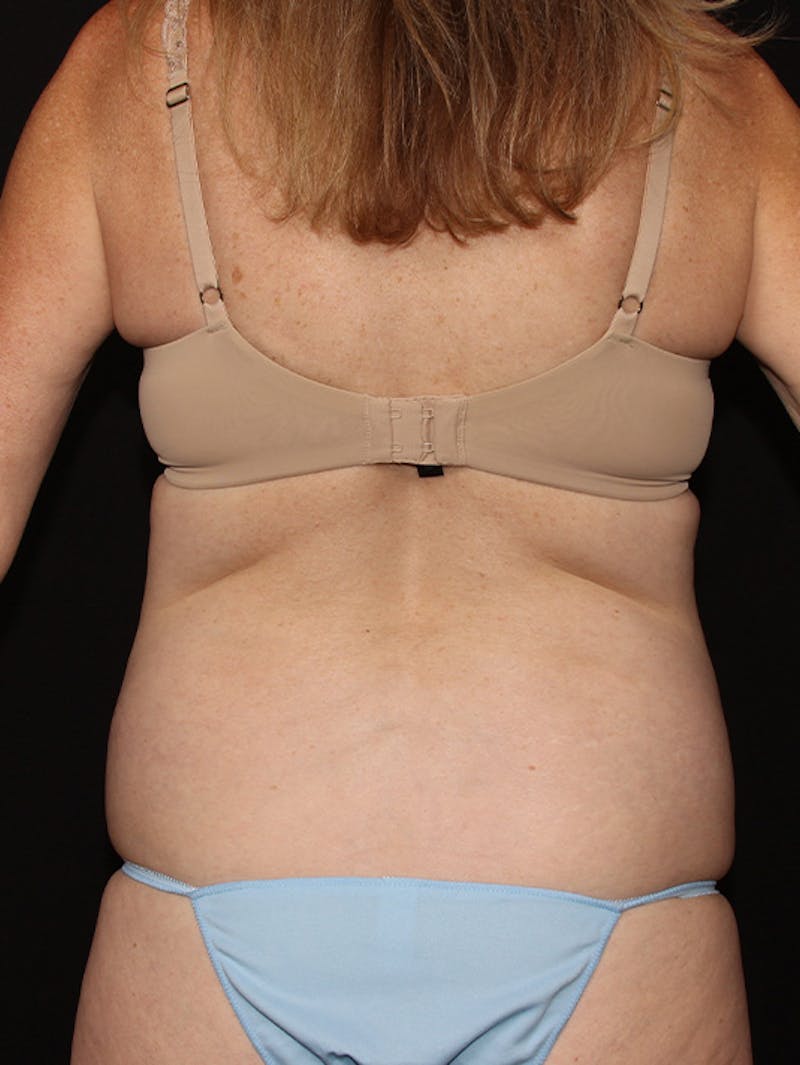 Abdominal Skin Excision Before & After Gallery - Patient 133023574 - Image 11