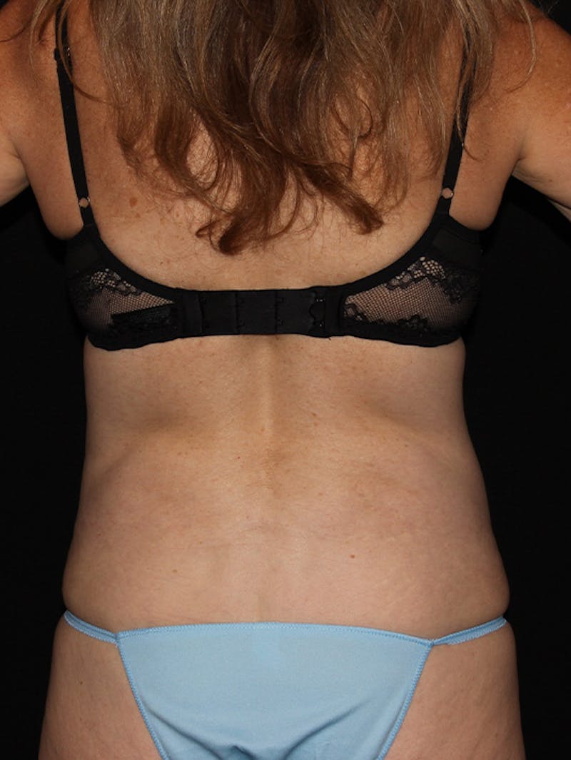 Abdominal Skin Excision Before & After Gallery - Patient 133023574 - Image 12