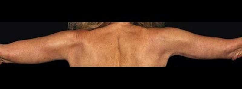Arm Lift Before & After Gallery - Patient 133023576 - Image 2