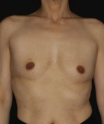Sientra Breast Implants Before & After Gallery - Patient 133023585 - Image 1