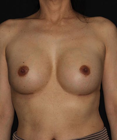 Sientra Breast Implants Before & After Gallery - Patient 133023585 - Image 2