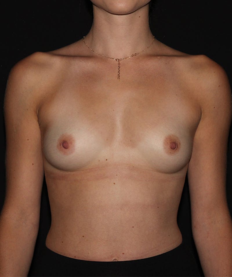 Breast Augmentation Before & After Gallery - Patient 133023589 - Image 1