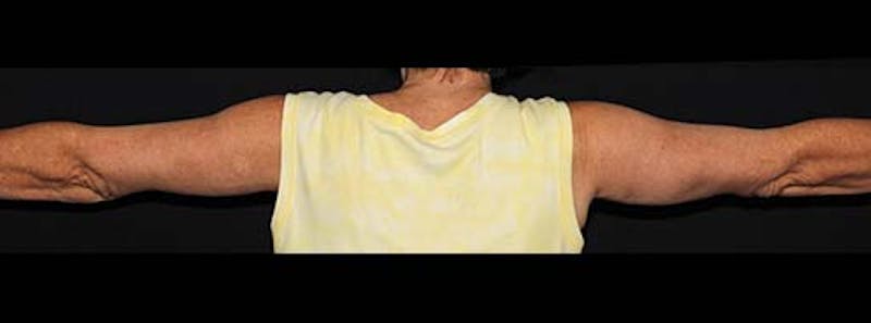 Arm Lift Before & After Gallery - Patient 133023582 - Image 2