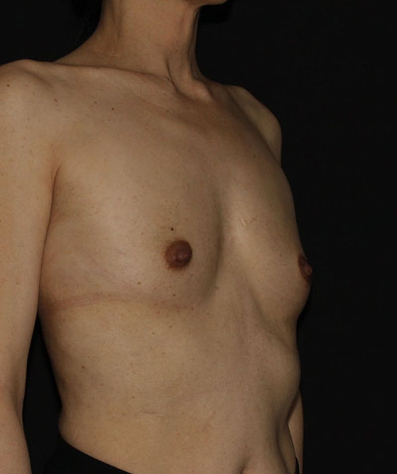 Sientra Breast Implants Before & After Gallery - Patient 133023585 - Image 3