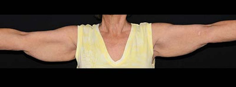 Arm Lift Before & After Gallery - Patient 133023582 - Image 3
