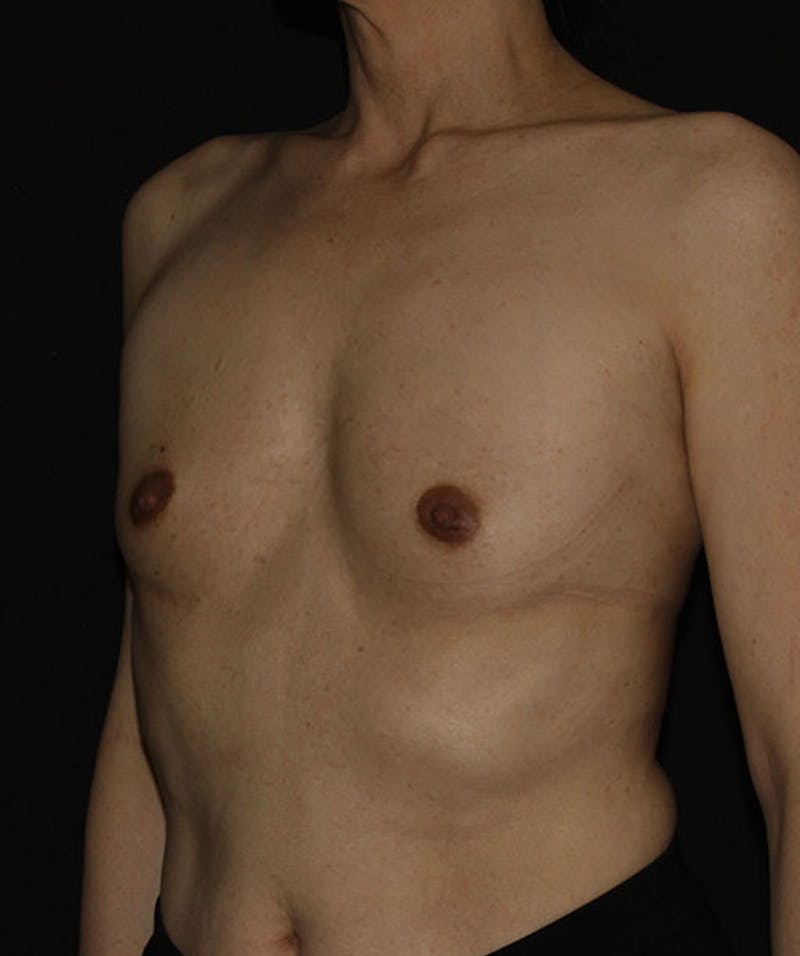 Sientra Breast Implants Before & After Gallery - Patient 133023585 - Image 7