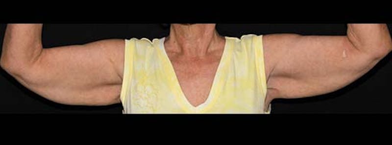Arm Lift Before & After Gallery - Patient 133023582 - Image 7