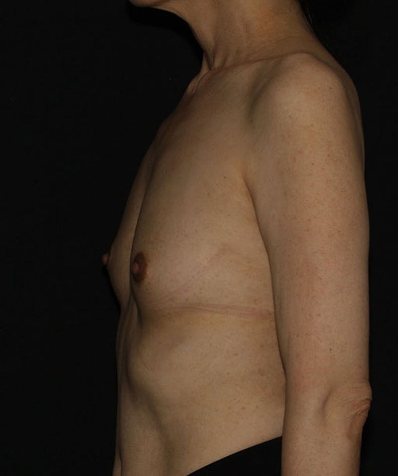 Sientra Breast Implants Before & After Gallery - Patient 133023585 - Image 9