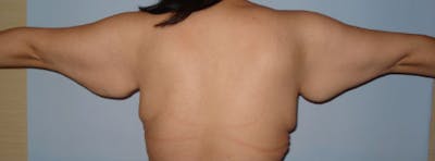 Arm Lift Before & After Gallery - Patient 133023587 - Image 1
