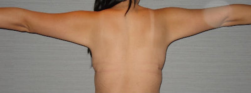 Arm Lift Before & After Gallery - Patient 133023587 - Image 2