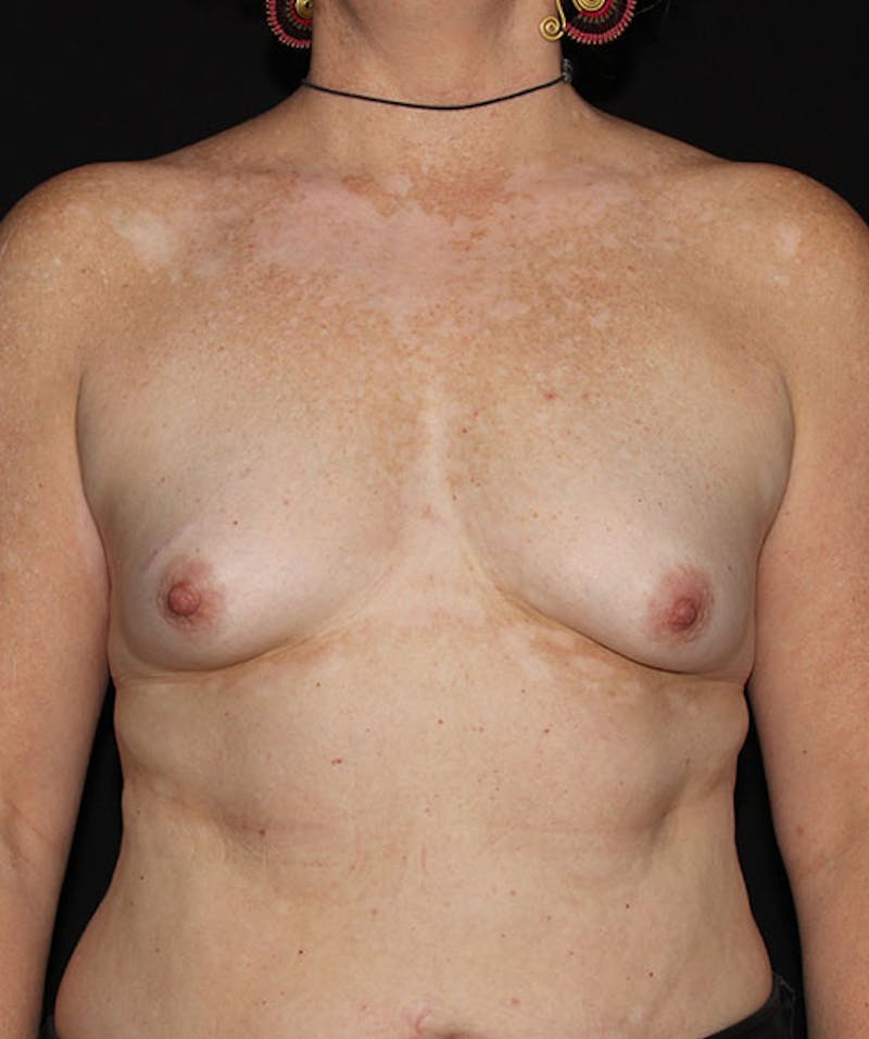 Sientra Breast Implants Before & After Gallery - Patient 133023594 - Image 1