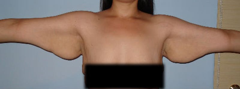 Arm Lift Before & After Gallery - Patient 133023587 - Image 3