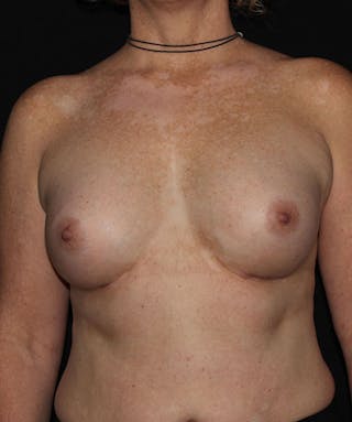 Sientra Breast Implants Before & After Gallery - Patient 133023594 - Image 2