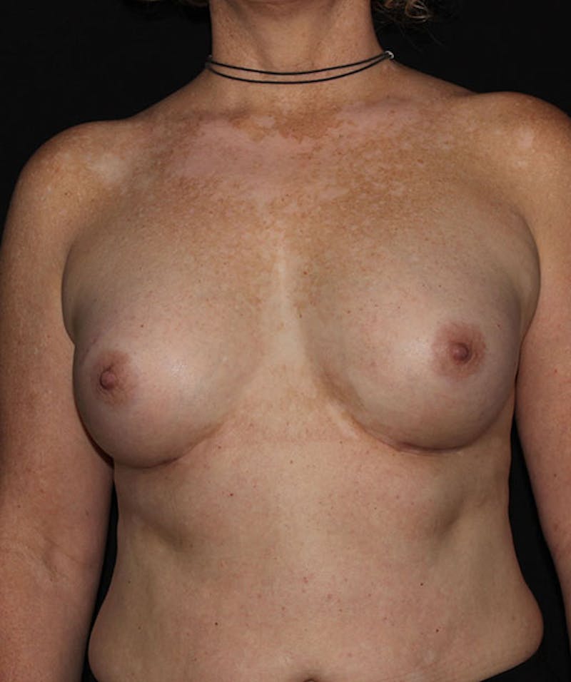 Sientra Breast Implants Before & After Gallery - Patient 133023594 - Image 2
