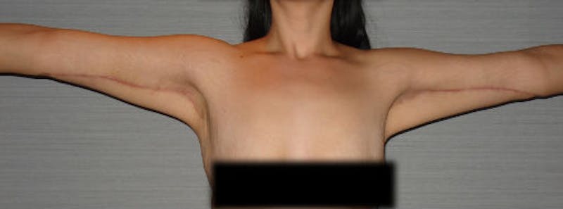 Arm Lift Before & After Gallery - Patient 133023587 - Image 4