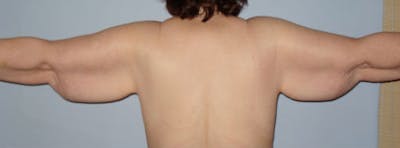 Arm Lift Before & After Gallery - Patient 133023591 - Image 1