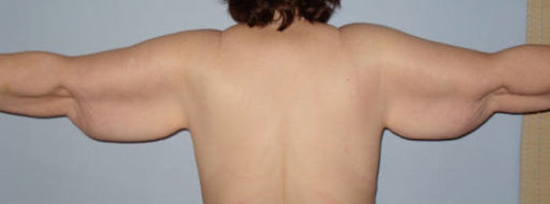 Arm Lift Before & After Gallery - Patient 133023591 - Image 1