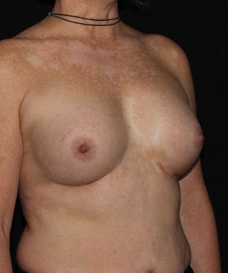 Sientra Breast Implants Before & After Gallery - Patient 133023594 - Image 4