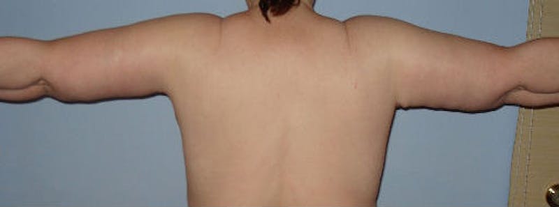 Arm Lift Before & After Gallery - Patient 133023591 - Image 2