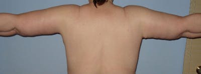 Arm Lift Before & After Gallery - Patient 133023591 - Image 2