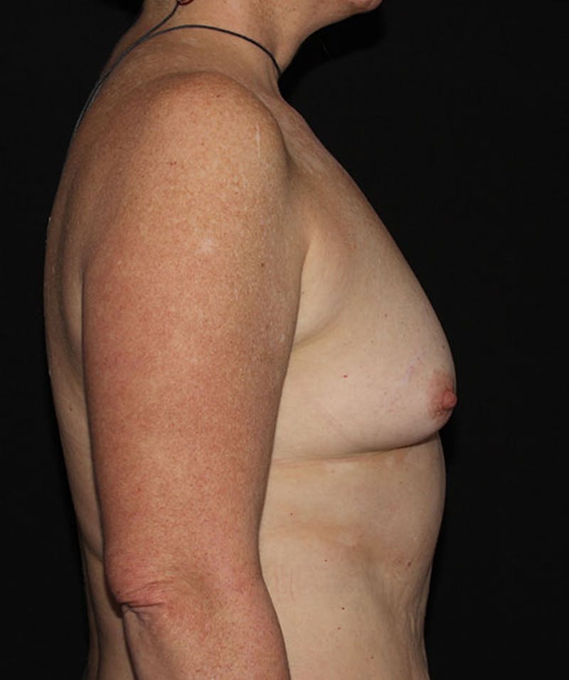 Sientra Breast Implants Before & After Gallery - Patient 133023594 - Image 5