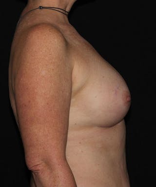 Sientra Breast Implants Before & After Gallery - Patient 133023594 - Image 6