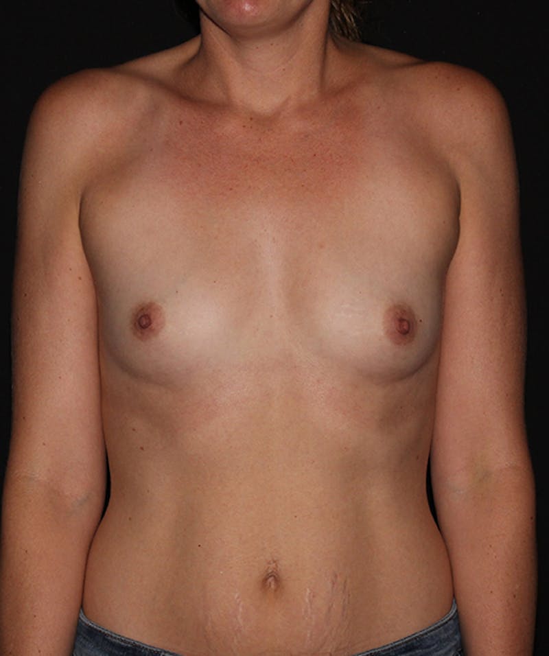 Breast Augmentation Before & After Gallery - Patient 133023601 - Image 1