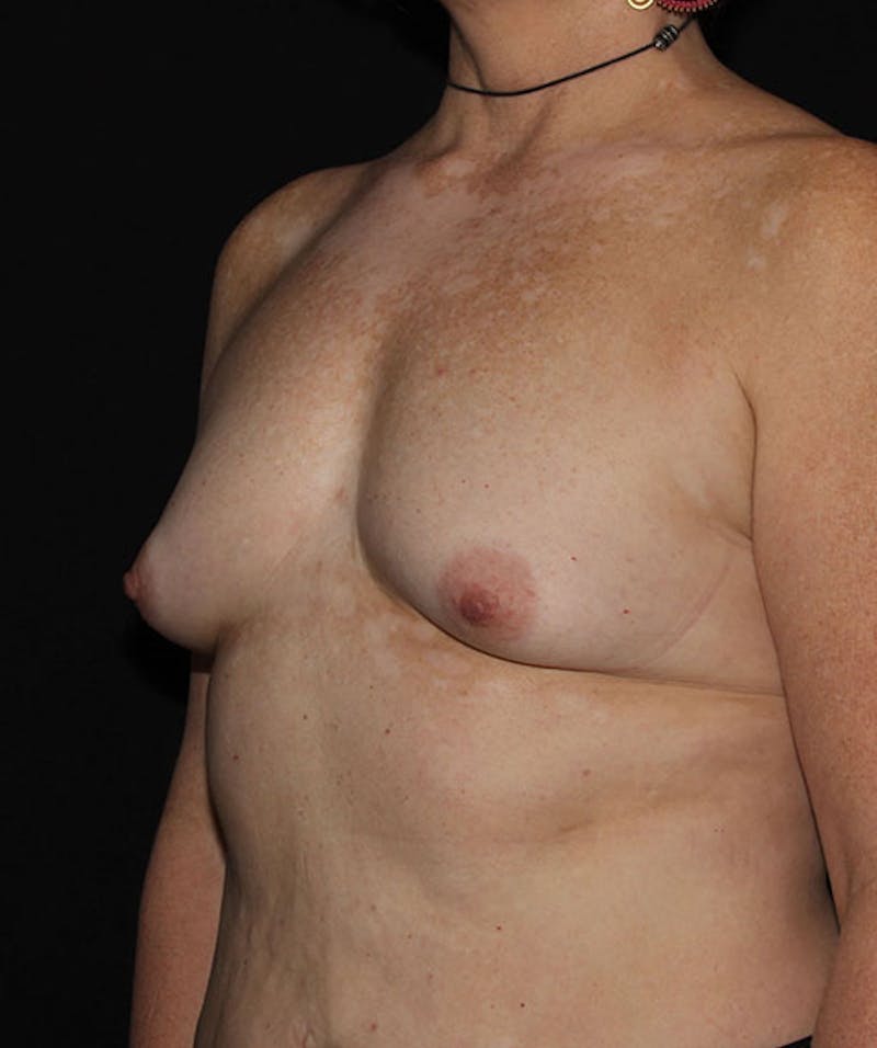 Sientra Breast Implants Before & After Gallery - Patient 133023594 - Image 7